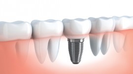 Smile Africa - Professional Dental Implants Services in Kenya