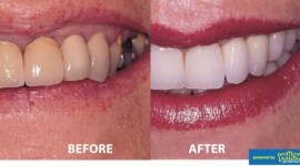 Smile Africa - The Best Dental Crown Clinic In Kenya