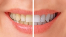Molars Dental Practice - Teeth whitening Services in Kenya