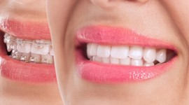 All Smiles Dental Practice - Self-Ligating Braces in Nairobi, Kenya
