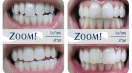 All Smiles Dental Practice - Zoom Teeth Whitening in Nairobi, Kenya