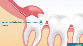 Family Dentistry - Are your wisdom teeth impacted?