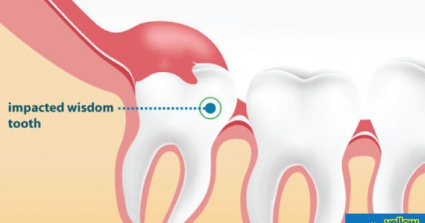Family Dentistry - Are your wisdom teeth impacted?