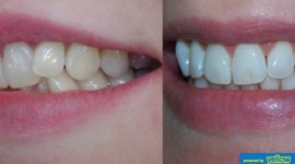 Family Dentistry - Orthodontic Treatment For Ideal Teeth Realignment