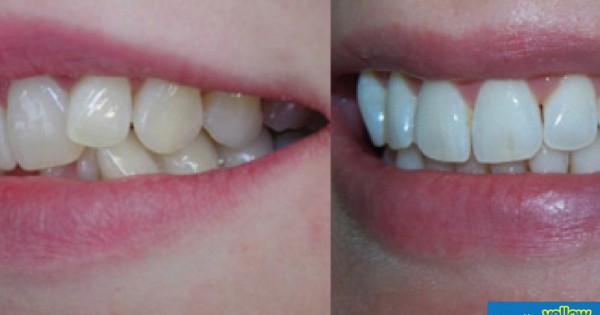 Family Dentistry - Orthodontic Treatment For Ideal Teeth Realignment