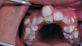 Family Dentistry - Hyperdontia- When Too Much Is Way Toooo Much