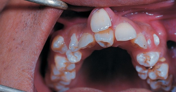 Family Dentistry - Hyperdontia- When Too Much Is Way Toooo Much