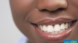 Family Dentistry - Restoration of Stained Teeth For a White Sparkling Smile
