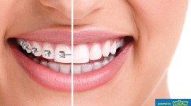 Family Dentistry - Crooked Teeth...?Overbite...? Unsightly gaps...?Buck Teeth - Get Orthodontic Expert Treatment