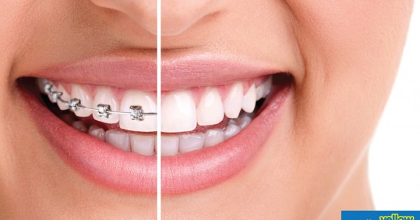 Family Dentistry - Crooked Teeth...?Overbite...? Unsightly gaps...?Buck Teeth - Get Orthodontic Expert Treatment