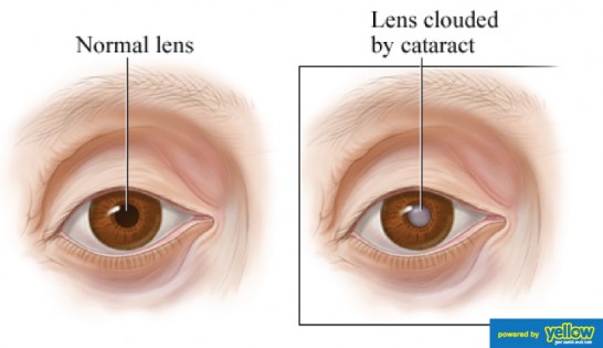 Jaff's Optical House Ltd - Cataracts- Prevention and Treatment 