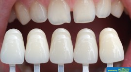 Family Dentistry - Consider Porcelain Veneers For  A Natural,Youthful Smile.
