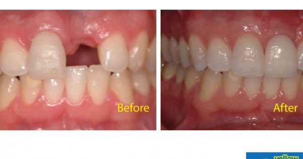 Smile Africa - Dental implant to restore that beautiful smile.