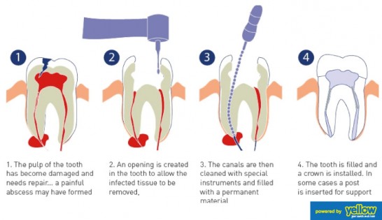 Swedish Dental Clinic, SDC - root canal treatment to save your tooth from extraction