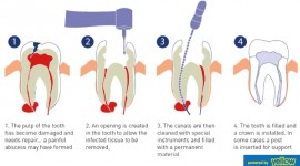 Swedish Dental Clinic, SDC - root canal treatment to save your tooth from extraction