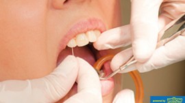 Swedish Dental Clinic, SDC - Professional dental extraction procedure