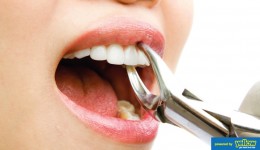 Dental Health Providers Clinics - Tooth Extraction Clinic in Nairobi