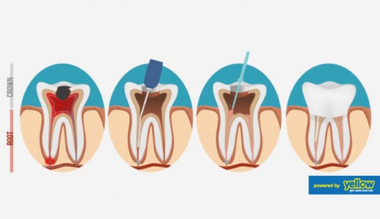 Family Dentistry - Get Root canal treatment to save damaged tooth.
