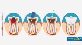 Family Dentistry - Get Root canal treatment to save damaged tooth.