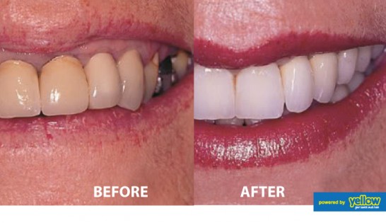 Smile Africa - Get your damaged teeth restored with Crowns at Smile Africa
