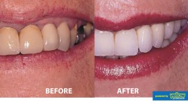 Smile Africa - Get your damaged teeth restored with Crowns at Smile Africa