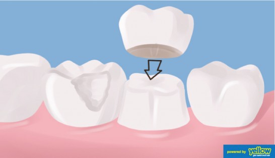 Swedish Dental Clinic, SDC - Dental Crowns used to repair tooth that are badly cracked, misshaped or discolored.