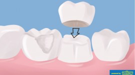 Swedish Dental Clinic, SDC - Dental Crowns used to repair tooth that are badly cracked, misshaped or discolored.