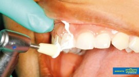 Smile Africa - Scaling and polishing procedures for effective teeth cleaning