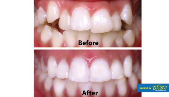 Smile Africa - Orthodontics services for treatment of dental anomalies (crowded and crooked teeth)
