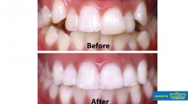 Smile Africa - Orthodontics services for treatment of dental anomalies (crowded and crooked teeth)