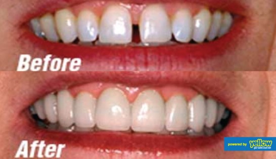 Smile Africa - Dental bonding to fill gaps and restore decayed or chipped teeth 