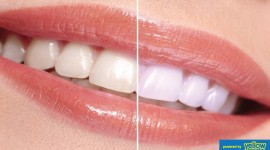 Family Dentistry - We will whiten-up your teeth professionally…