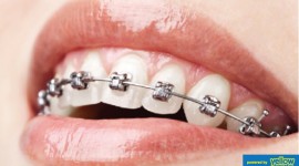 Dental Health Providers Clinics - Modern Dental Braces in Nairobi  