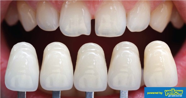 Balm Dental Care Centre  - Porcelain veneers to mask discolorations and to improve a smile.