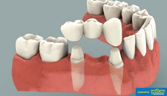 Family Dentistry - Dental Bridges Experts