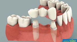 Family Dentistry - Dental Bridges Experts