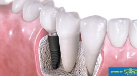 Family Dentistry - Dental implants done by expert dentists...