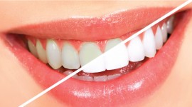 Dental Health Providers Clinics - Tips For Whitening Your Teeth Naturaly... 