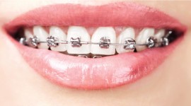 Molars Dental Practice - Dental Braces in Nairobi