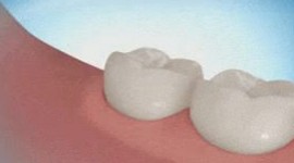 Dental Health Providers Clinics - What is a Wisdom Teeth?