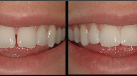 Balm Dental Care Centre  - Teeth Bonding For Repairing Chipped Teeth.
