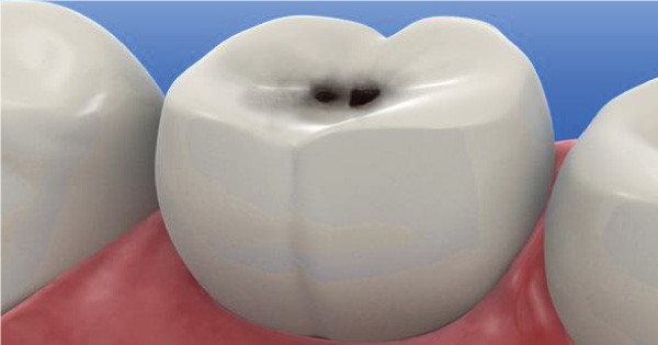 Family Dentistry - What is Dental Caries? 