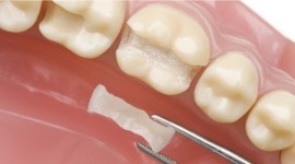 Balm Dental Care Centre  - Dental Filling To Restore A Decayed Tooth 