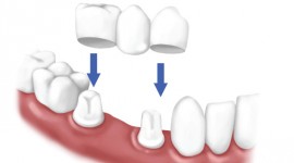 Balm Dental Care Centre  - Dental Crown Ideal To Cover Damaged Tooth