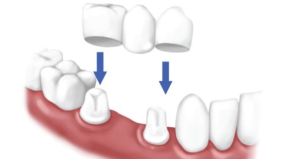 Balm Dental Care Centre  - Dental Crown Ideal To Cover Damaged Tooth