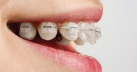 Dental Health Providers Clinics - Signs and Symptoms of Orthodontics