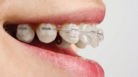 Dental Health Providers Clinics - Signs and Symptoms of Orthodontics