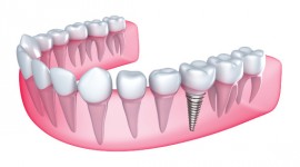 Family Dentistry - Advanced Dental Implants Solutions 
