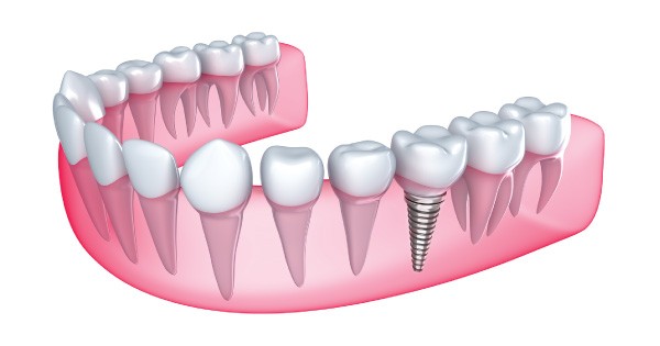 Family Dentistry - Advanced Dental Implants Solutions 