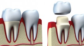 Molars Dental Practice - The Best Dentists To Restore Broken Tooth Using Dental Crown